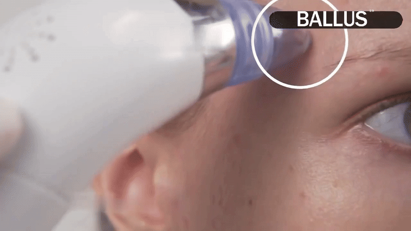 Blackhead Remover Tool 💆‍♀ ALSOUQMART